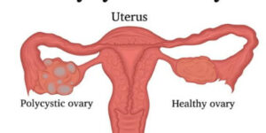 다낭성 난소증후군 임신